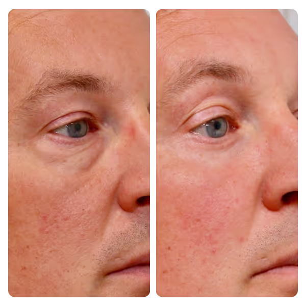 Eyelid Surgery (Blepharoplasty) in Turkey